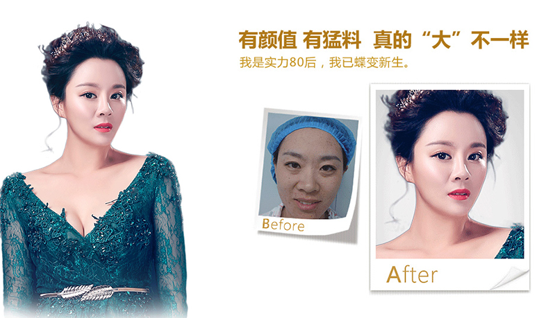 漯河脂肪移植、隆鼻